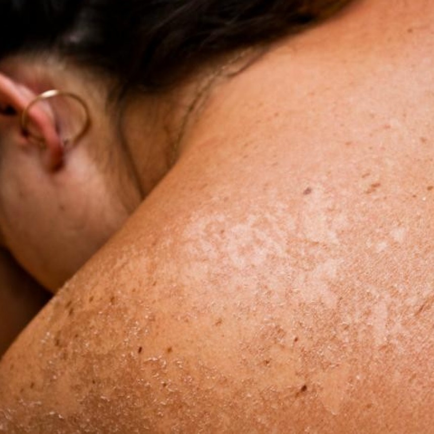 Lalcec Luján recomienda cuidar la piel para evitar el cáncer